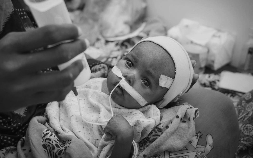 Saleh im Krankenhaus in Aden | © UNICEF/UNI313433 Jemen: Die schwer mangelernährte Saleh bei der Behandlung im Krankenhaus in Aden