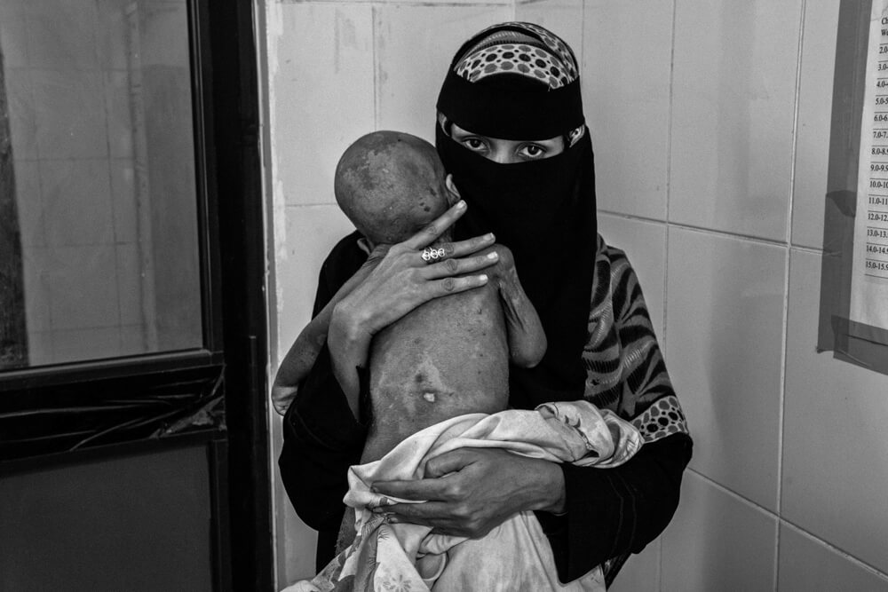 Fawaz im Arm seiner Mutter | © Giles Clarke for UNOCHA Jemen: Fawaz im Arm seiner Mutter