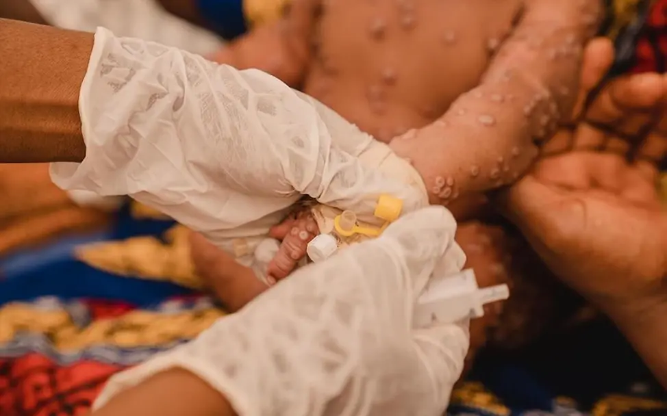 Mpox Virus: Ein Kind wird im Kamanyola-Krankenhaus in Süd-Kivu im Kongo gegen Mpox behandelt. | © UNICEF/Benekire Mpox Virus: Ein Kind wird im Kamanyola-Krankenhaus in Süd-Kivu im Kongo gegen Mpox behandelt.